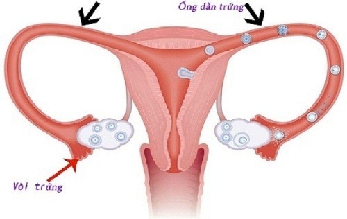 Viêm nhiễm vòi trứng, trực khuẩn lao, nạo phá thai... là nguyên nhân gây ra tình trạng thai ngoài tử cung
