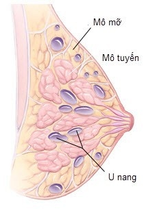 U nang tuyến vú - Nguyên nhân, triệu chứng và cách điều trị