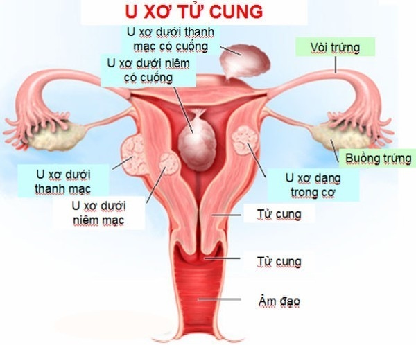 U xơ tử cung có nguy hiểm không?