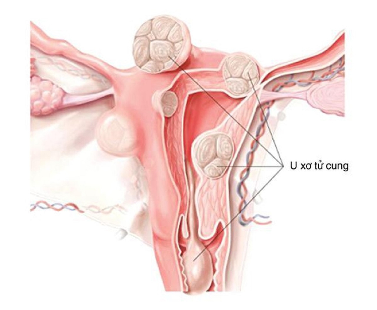 Biến chứng của u xơ tử cung gây ảnh hưởng lớn tới sức khỏe