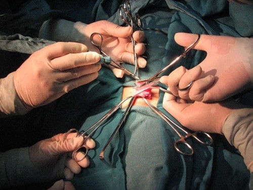 U xơ lớn hơn 5 cm mới phải mổ.