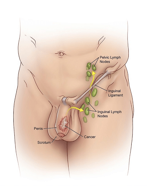 Ung thư dương vật &#8211; nguyên nhân, triệu chứng và cách điều trị