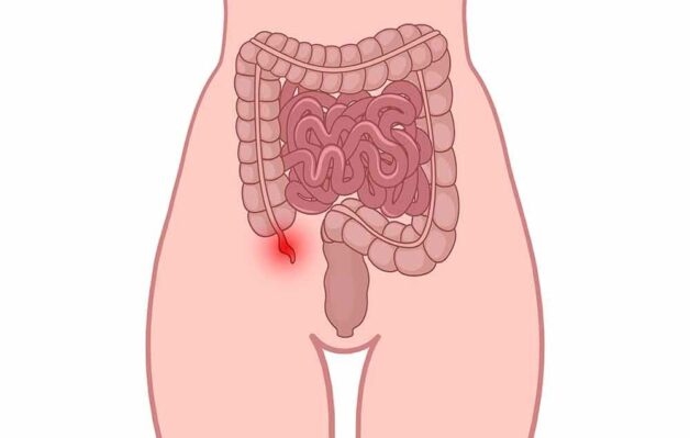 Ruột thừa nối liền với manh tràng