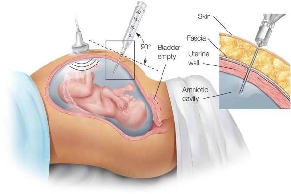 Thai phụ nên lựa chọn các cơ sở y tế uy tín để thực hiện chọc ối xét nghiệm.