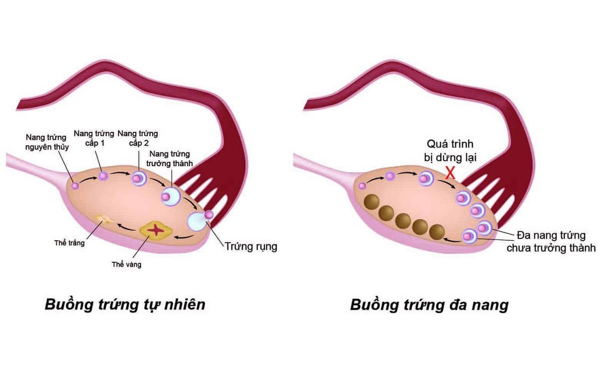 Điều trị buồng trứng đa nang hiệu quả ở thu cúc