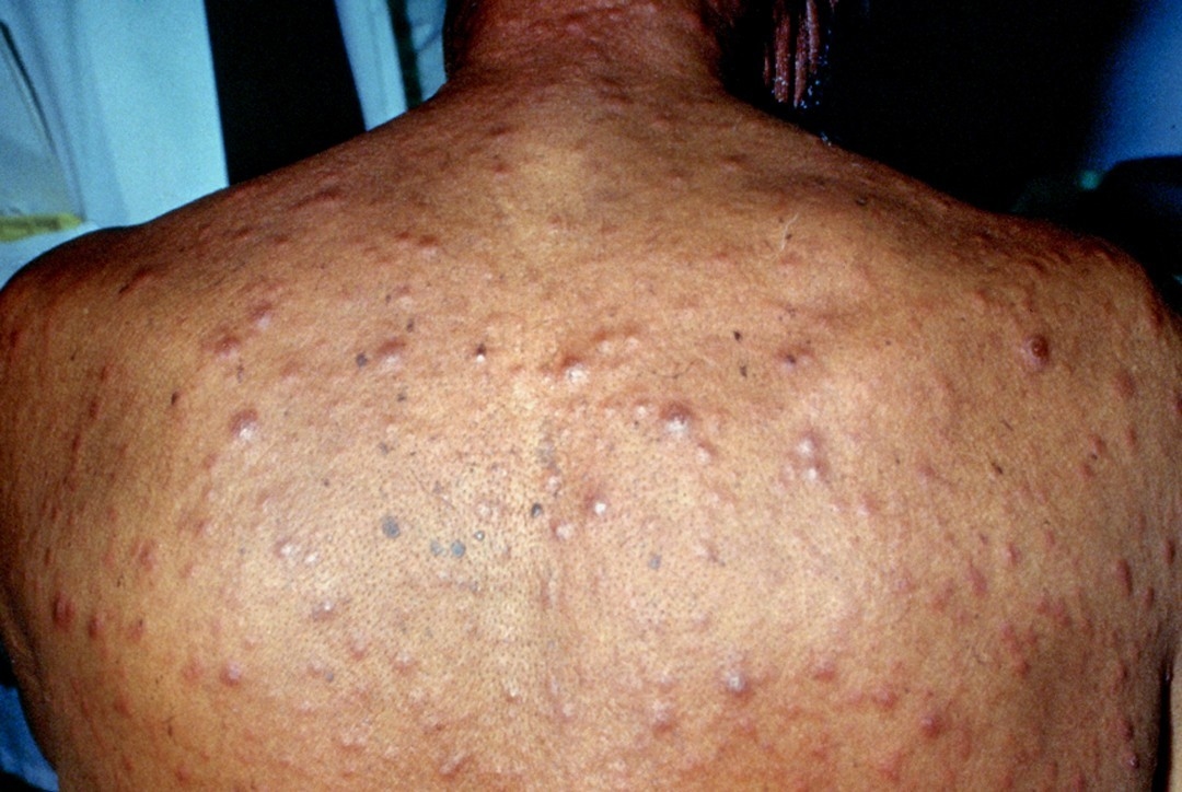 Nguyên nhân gây bệnh giang mai