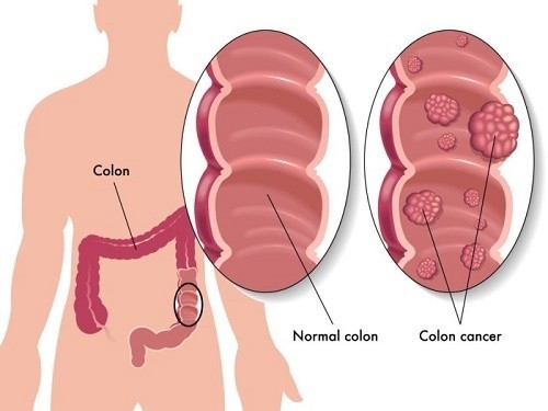 Mổ polyp dạ dày  mang lại hiệu quả cao