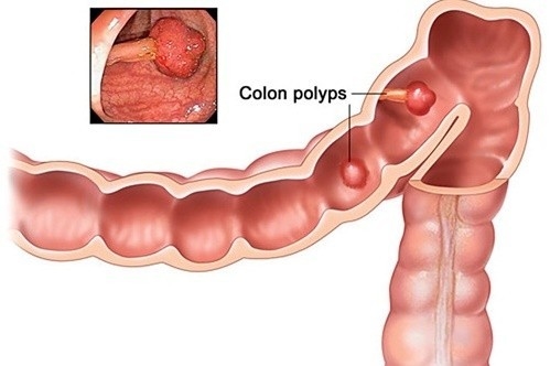 Polyp dạ dày có nguy hiểm không?