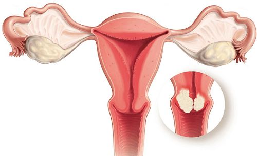 Sau mổ polyp cổ tử cung cần chú ý gì? là câu hỏi nhiều chị em thắc mắc