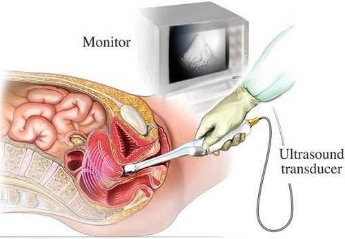 Siêu âm đầu dò giúp quan sát rõ hơn các cơ quan sinh dục, phát hiện các bệnh lý vùng tiểu khung 