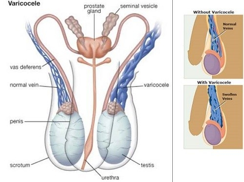 Triệu chứng giãn tĩnh mạch thừng tinh