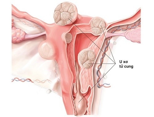 U xơ tử cung là những cục u nhỏ gồm các tế bào cơ mềm và các mô phát triển trong thành tử cung