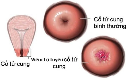 Viêm lộ tuyến có gây khó thụ thai?