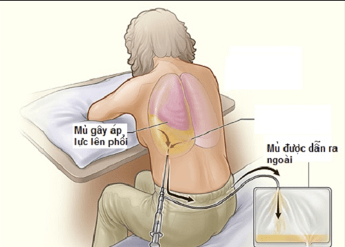 Người bệnh còn dễ mắc áp xe phổi, tràn dịch màng phổi...gây nguy hiểm tới tính mạng nếu không phát hiện và điều trị sớm