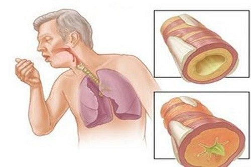 Lao phổi là bệnh nguy hiểm và có tốc độ lây lan nhanh chóng 