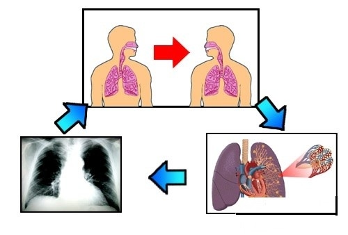 Lao kháng thuốc là tình trạng nhờn thuốc khiến bệnh tái đi tái lại và có chiều hứng nặng hơn, ảnh hưởng tới sức khỏe
