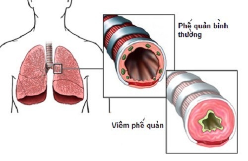 Viêm phế quản mạn tính là do mất cân bằng giữa cơ chế bảo vệ của cơ thể và yếu tố độc hại của môi trường.