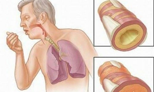 Giãn phế quản do nhiều nguyên nhân gây ra nên người bệnh cần đi khám khi có dấu hiệu cảnh báo bệnh