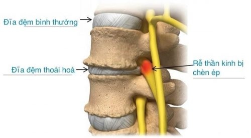 Mất nước đĩa đệm là một trong những biểu hiện của quá trình lão hóa đĩa đệm. 