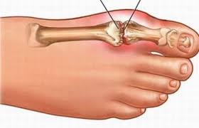 Đau khớp ngón chân cái là bệnh thường gặp ở nhiều người