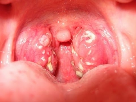 Amidan bị viêm có thể gây ảnh hưởng đến sức khỏe