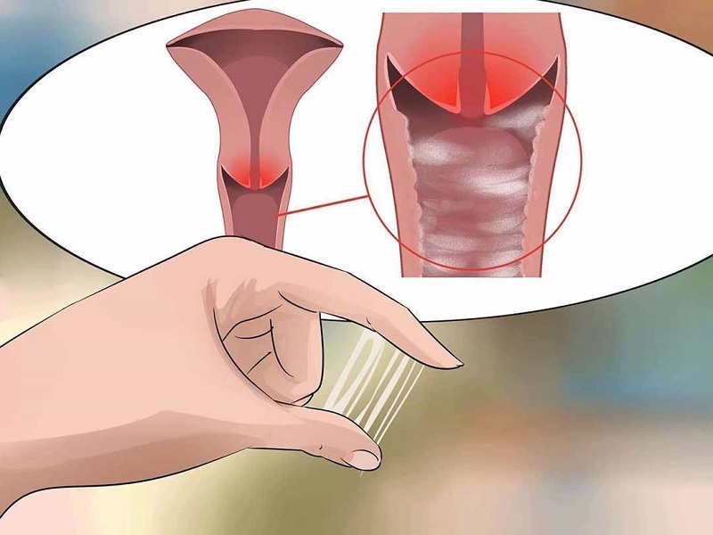 Khí hư làm khô cứng quần lót kèm theo những bất thường khác cảnh báo nhiều bệnh lý nguy hiểm