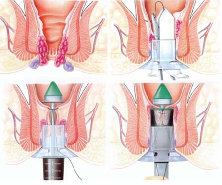 Cắt trĩ là phương pháp hiệu quả giúp điều trị bệnh trĩ