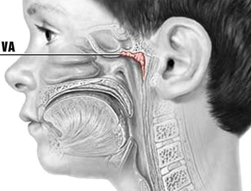 Bị viêm VA nguy hiểm như thế nào?