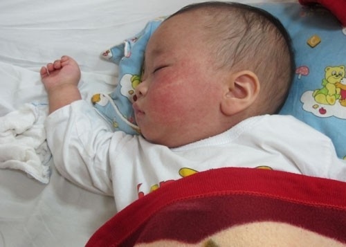 Trẻ bị sốt phát ban cha mẹ cần chăm sóc trẻ đúng cách
