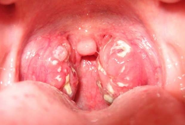 Cần cắt amidan khi nào?bệnh lý thường găp ở trẻ em