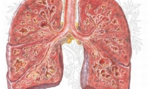 Xơ phổi là một bệnh nghiêm trọng gây sẹo tiến triển của mô phổi