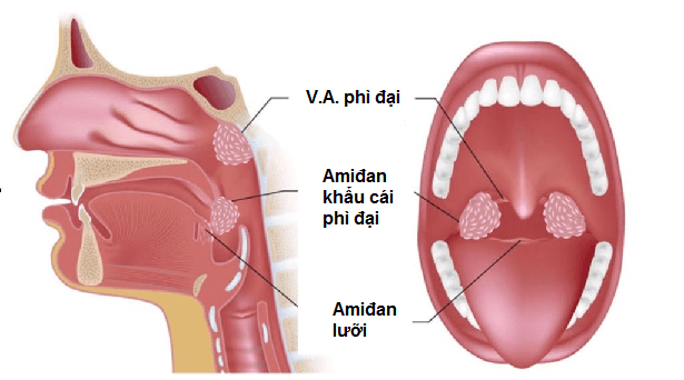 Phì đại VA có cần nạo không?  triệu chứng của bệnh như thế nào