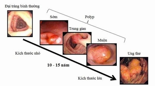 Hình ảnh quá trình polyp tiến triển thành ung thư đại trực tràng