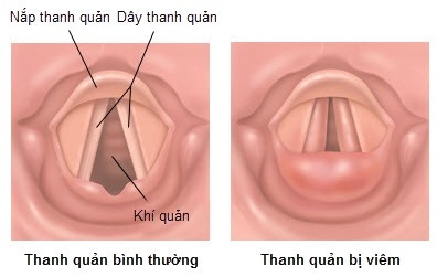 Viêm thanh quản khi nào cần gặp bác sĩ?