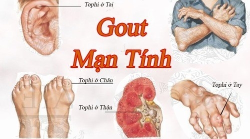Đau nhức xương khớp bệnh gì?