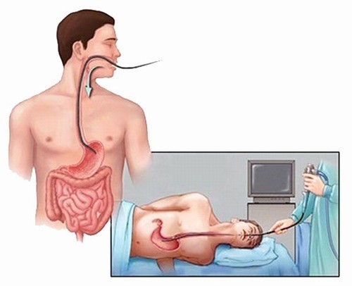 Nội soi cắt polyp dạ dày hiệu quả tại Thu Cúc