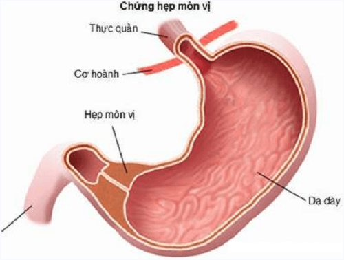 Hẹp môn vị là biến chứng thường gặp do viêm loét dạ dày