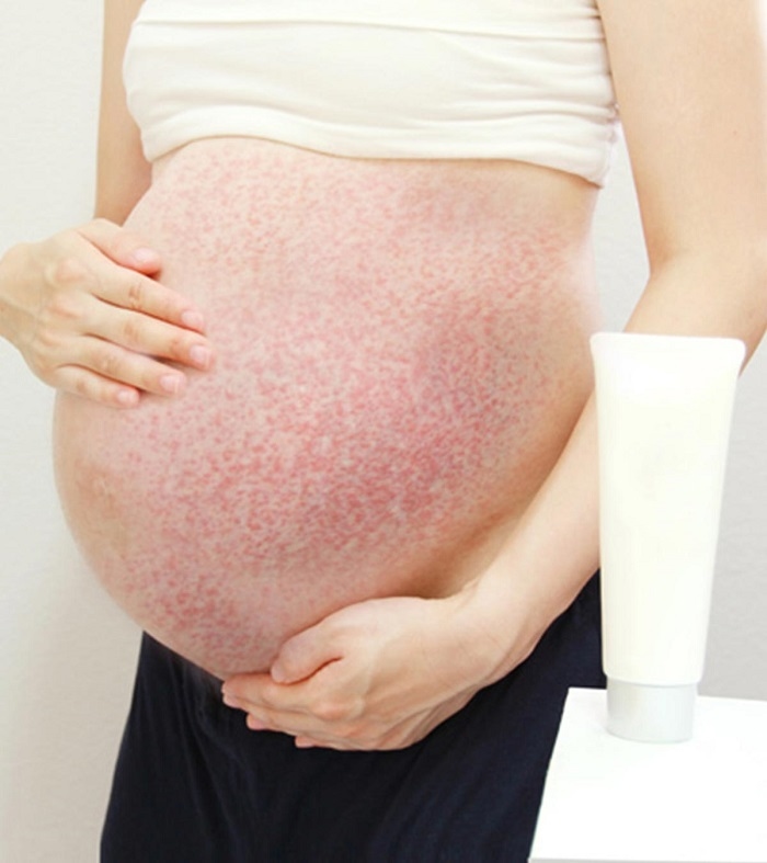 Bà bầu nổi mẩn ngứa ở da bụng nguyên nhân và cách xử trí