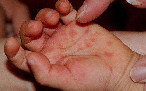 trẻ bị tay chân miệng phải làm gì