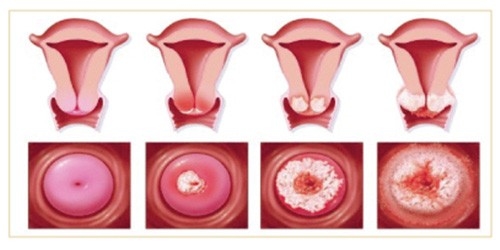 Viêm lộ tuyến độ 3 và cách khắc phục