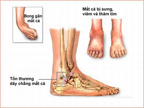 Tìm Hiểu Bong gân là gì & Xử Lý Khi bị bong gân 