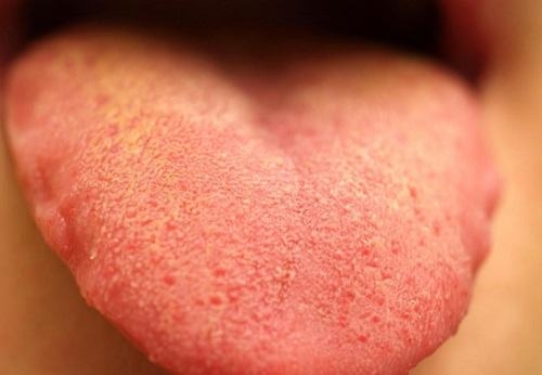 Bệnh viêm lưỡi là một trong các bệnh về lưỡi