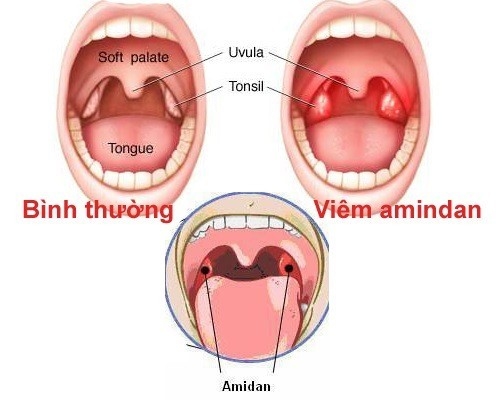 Cắt amidan ảnh hưởng gì không?cần lưu ý điều gì