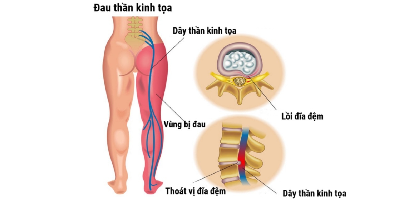 Những điều cần biết về đau thần kinh tọa