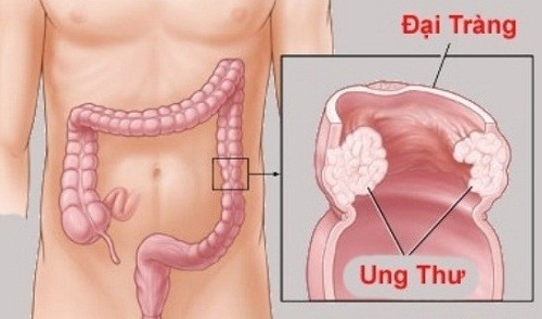 Hình ảnh ung thư đại tràng