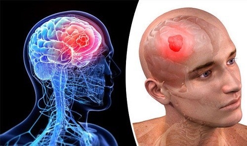 Hình ảnh ung thư não biến chứng nguy hiểm