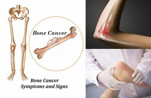 Mức độ nguy hiểm của bệnh ung thư xương