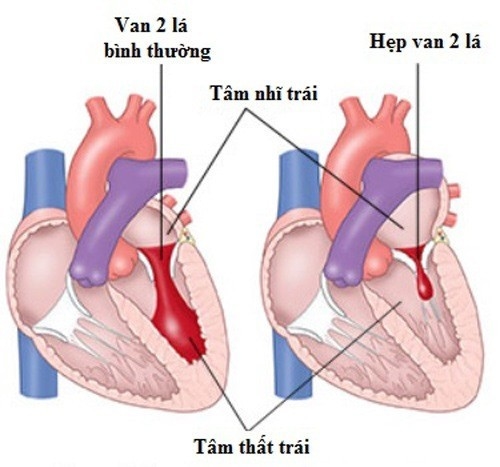 Hở van tim là bệnh lý tim mạch thường gặp