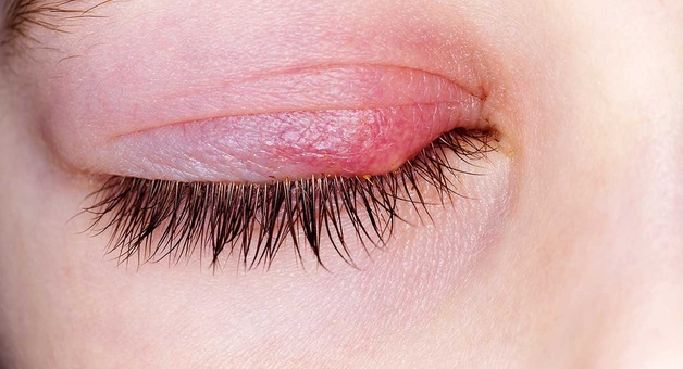 Ngứa mí mắt là bệnh gì