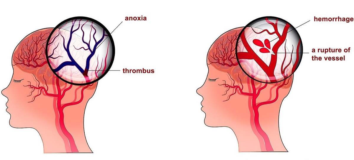 Bệnh nhồi máu não và cách điều trị